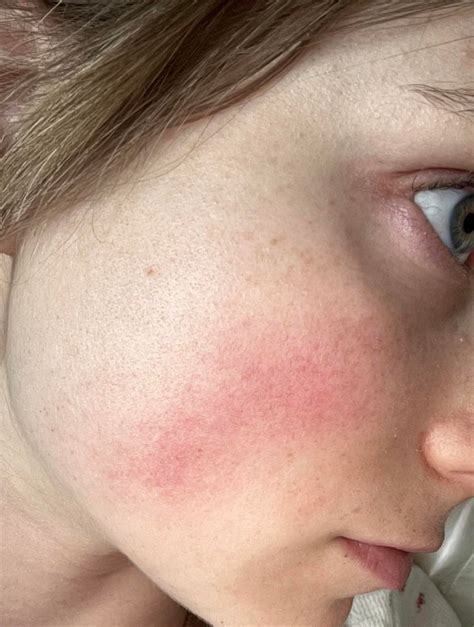 fish oil rosacea